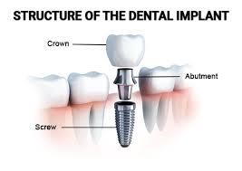 Passive Coatings for Dental Implants