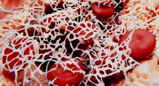 Blood clot (thrombus). Erythrocytes (red blood cells) are trapped within a fibrin mesh. Erythrocytes (red blood cells) are trapped within a fibrin mesh.