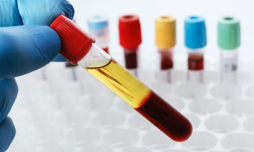 Lab technician holding a test tube of blood sample after being centrifuged Blood drawn from a patient with Serum separate in the chemistry laboratory. Lab technician holding a test tube of blood sample after being centrifuged